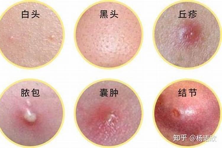 马铃薯长疙瘩是什么病症？